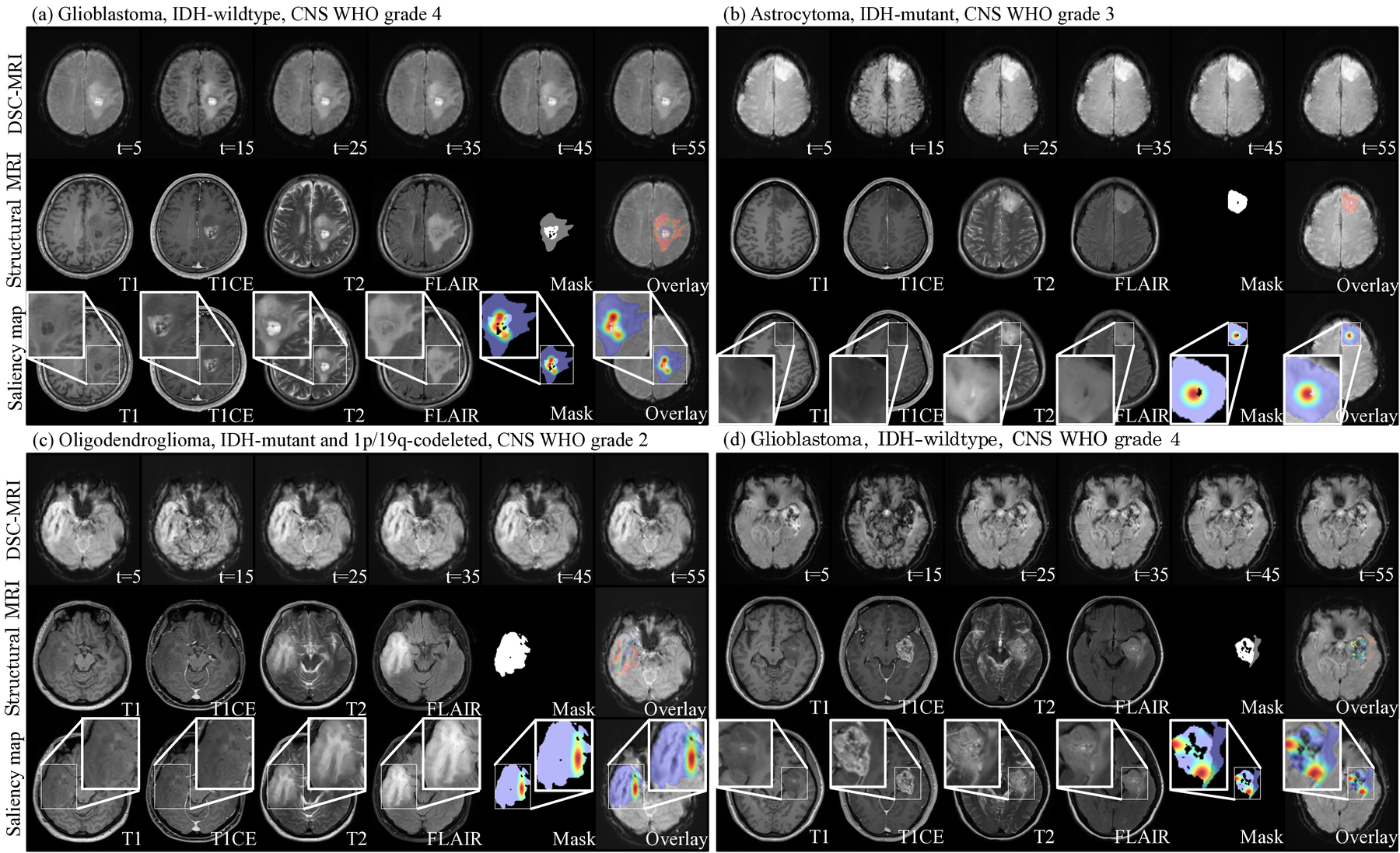 Gradient-based saliency maps across glioma molecular subtypes